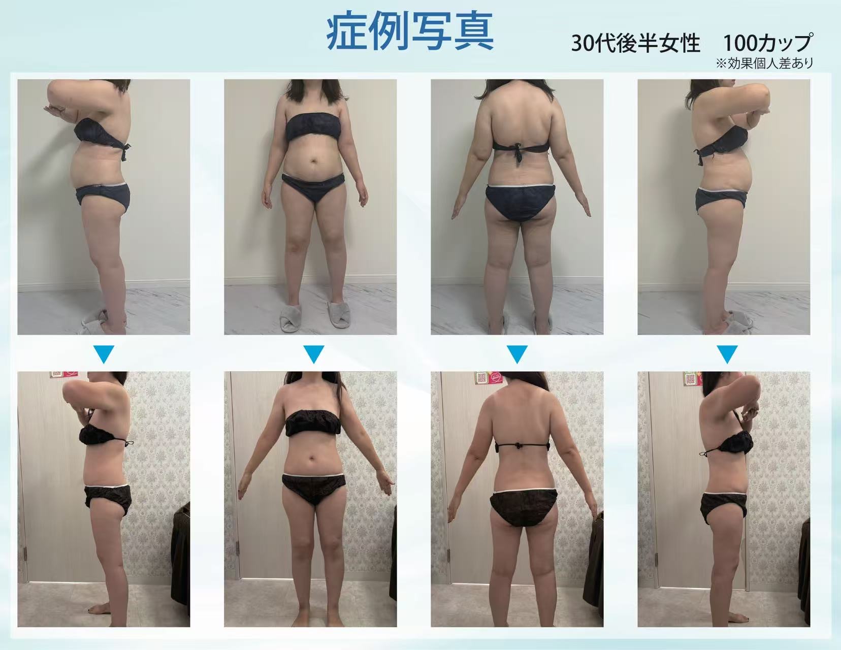 症例写真 30代後半女性 100カップ
