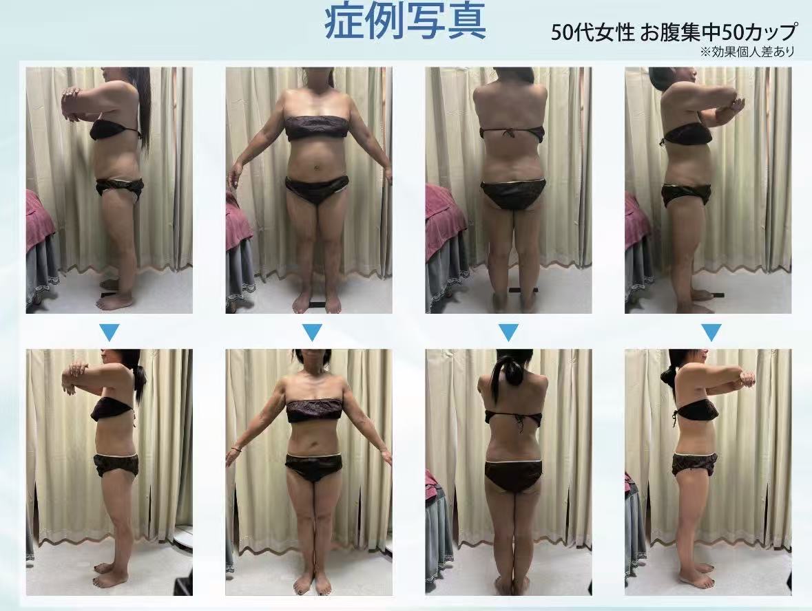 症例写真 50代女性 お腹集中50カップ