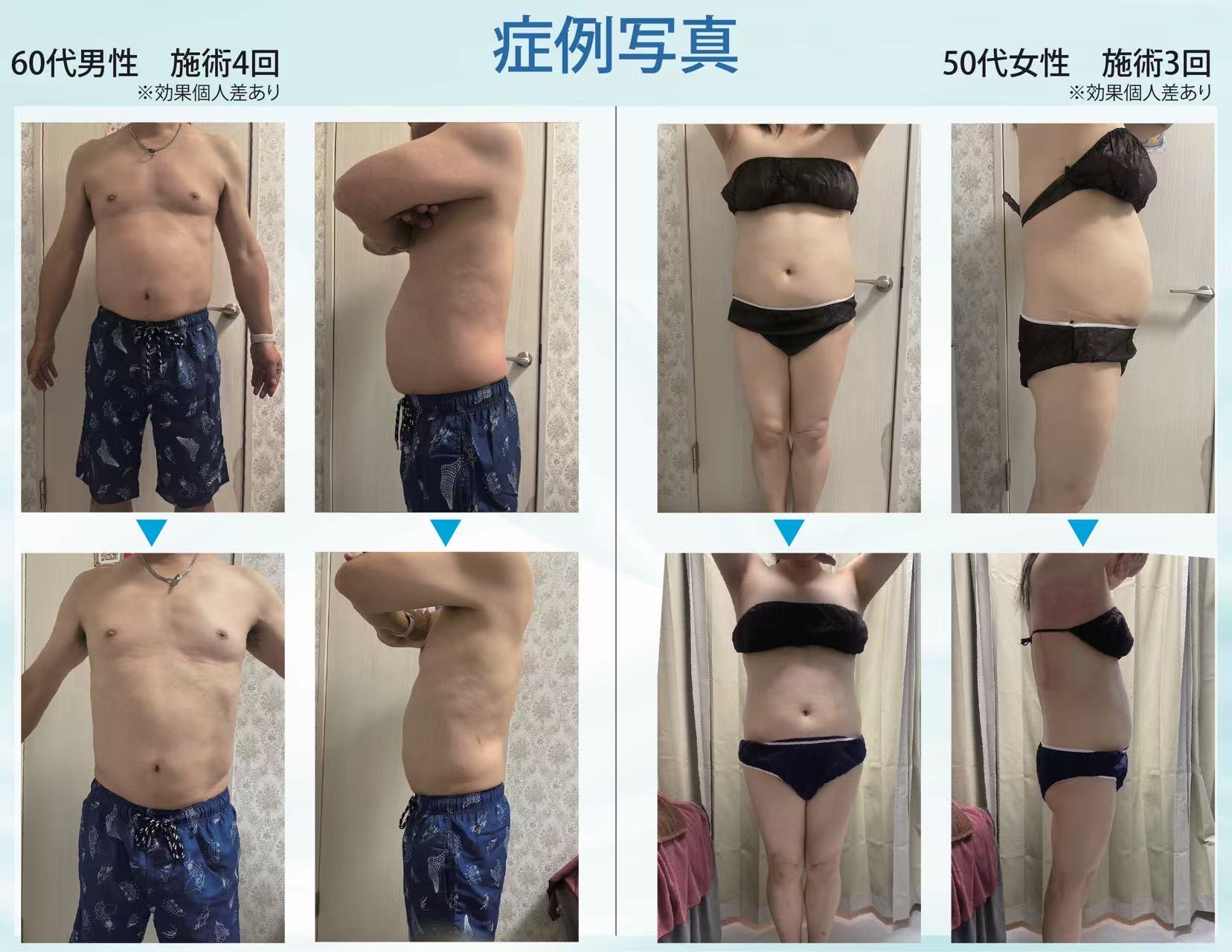 脂肪冷却施術の Before & After